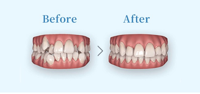 アイテロで治療前後の歯並びをシミュレーション